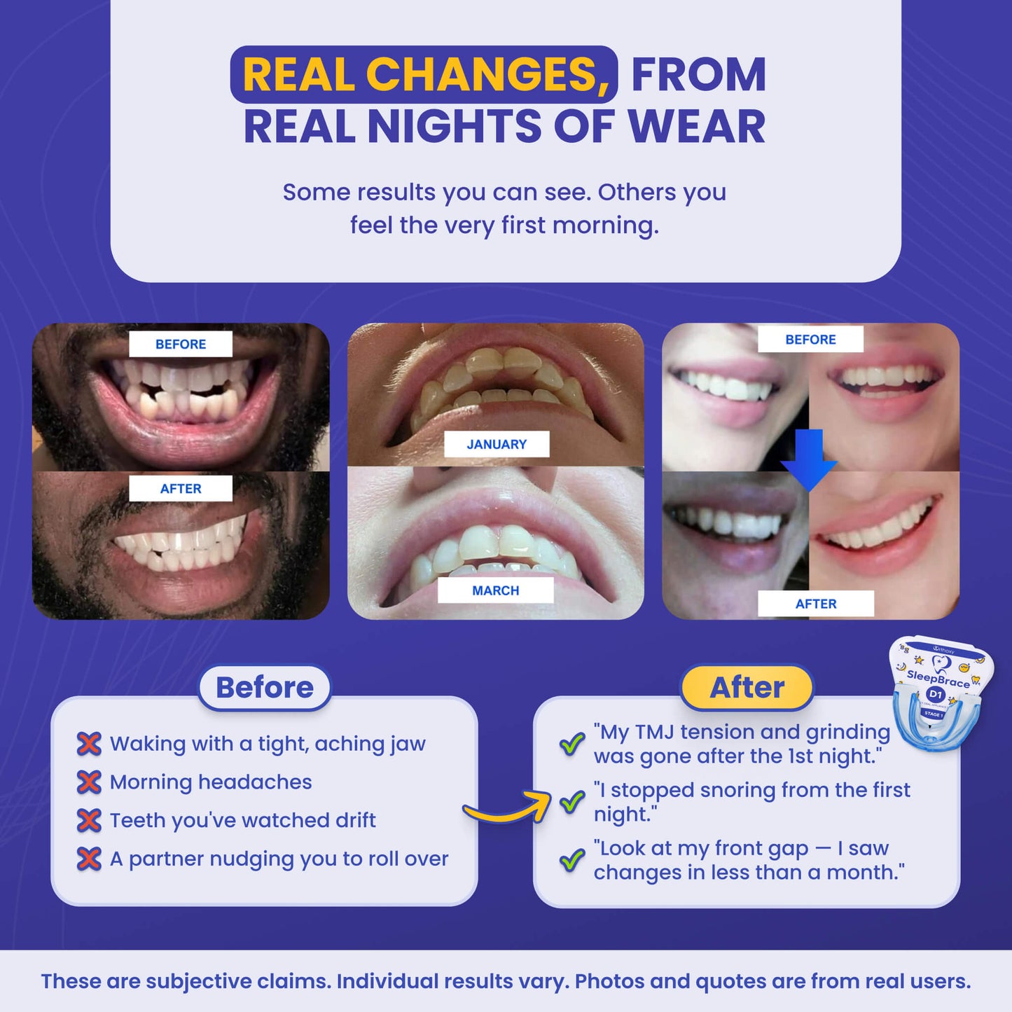 SleepBrace® Dental