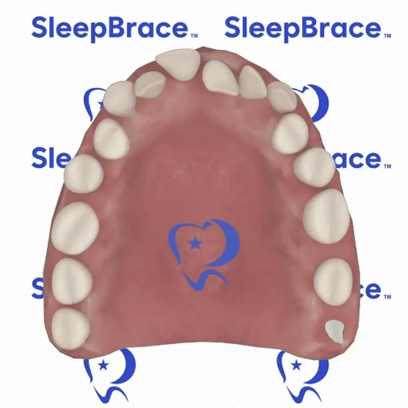 3D Demonstration of SleepBrace Dental (Not Real)